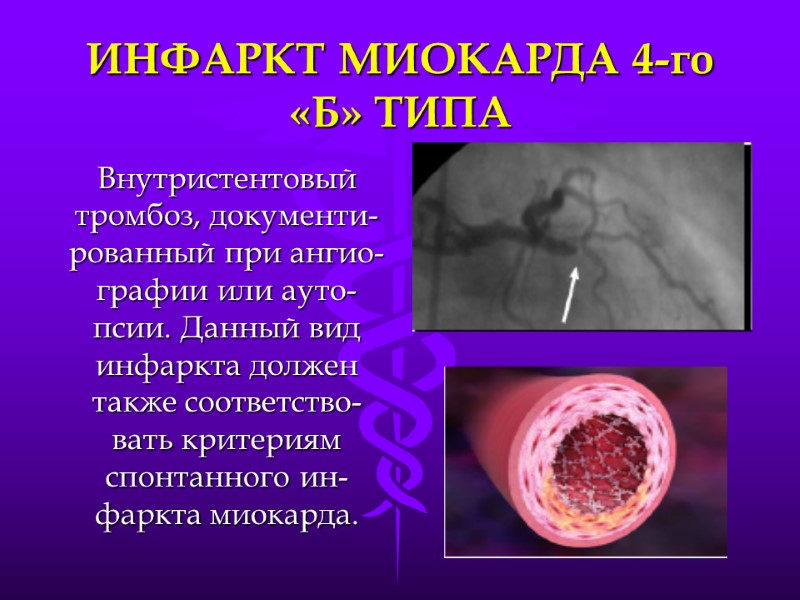 ИНФАРКТ МИОКАРДА 4-го «Б» ТИПА Внутристентовый тромбоз, документи-рованный при ангио-графии или ауто-псии. Данный вид